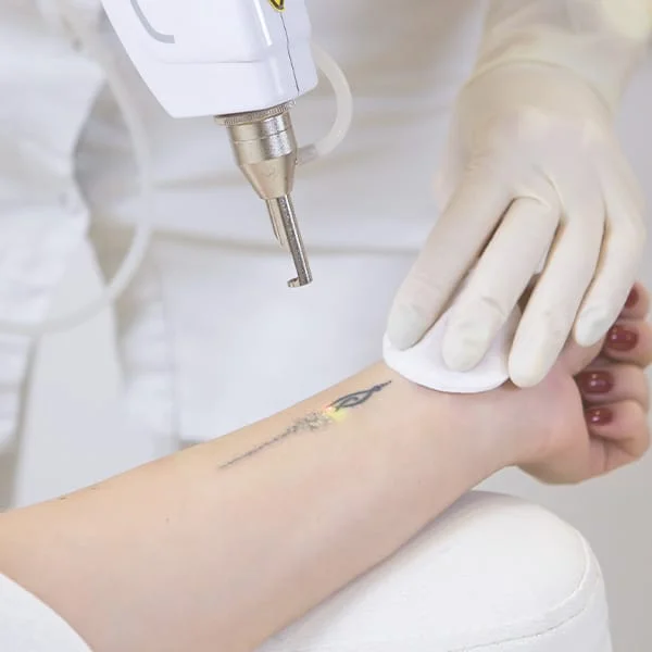 profissional realizando remoção de tatuagem à laser em braço de paciente do sexo feminino